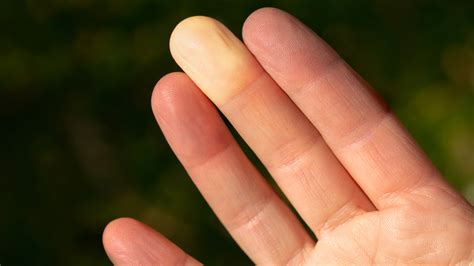 Raynaud’s Syndrome: Treatment and Pictures - GoodRx