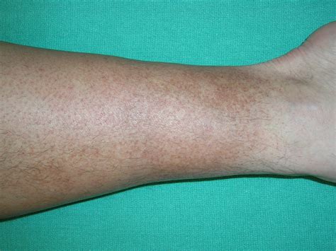 Leg Discoloration Treatment and Causes | Leg Discoloration Specialist Maryland