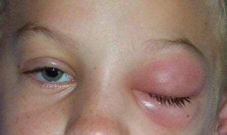 Eye Orbital Cellulitis