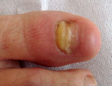 Uneventful healing and regrowth of approximately 40% of the nail is... | Download Scientific Diagram