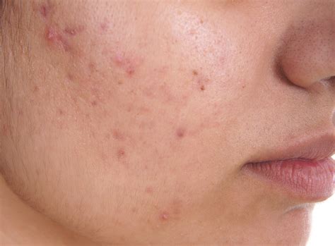 Hormonal and Cystic Acne From PCOS: Causes, Symptoms, and Treatment | Veera