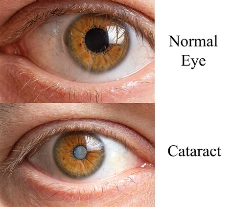 Posterior Capsular Opacity (PCO) Eye Treatment Cost – Eye Surgery Guide