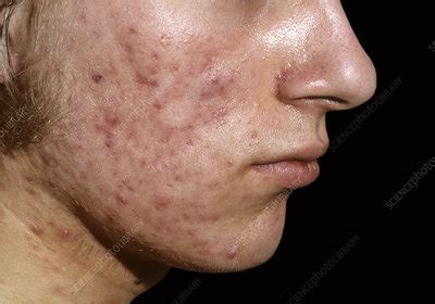 Acne conglobata - Stock Image - C038/4490 - Science Photo Library