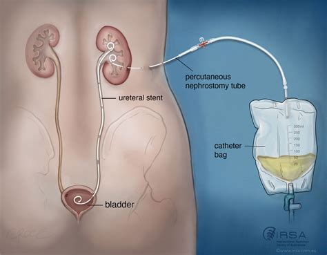 Nephrostomy | Interventional Radiology Procedure for Kidney Care