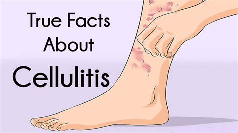 Pin by Julia on Lymphedema (With images) | True facts, Facts, Lymphedema