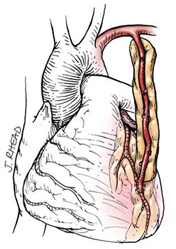 Why is LIMA graft superior to saphenous venous graft in CABG ? | Dr.S.Venkatesan MD