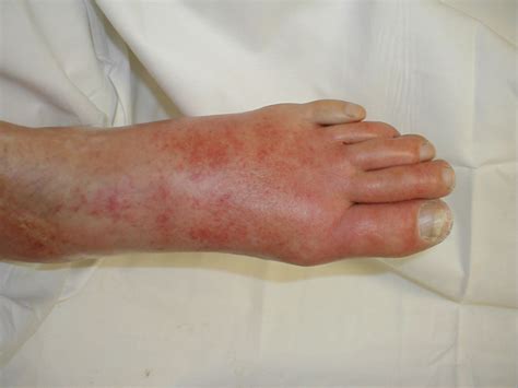 Cellulitis On Top Of Foot