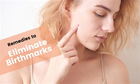 7 Effective Home Remedies To Eliminate Birthmarks - Clear Skin Clinic