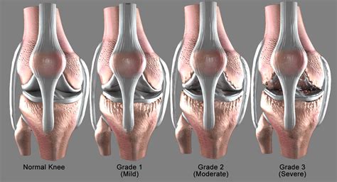 Osteoarthritis severe condition knee 3D model - TurboSquid 1410244