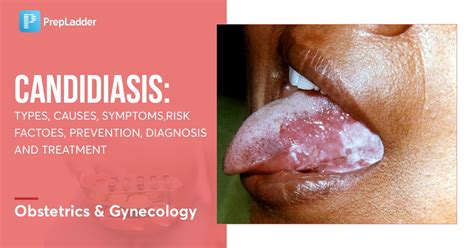 Candidiasis In Women