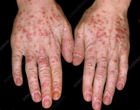 Guttate psoriasis on a man's hands - Stock Image - C058/5880 - Science Photo Library