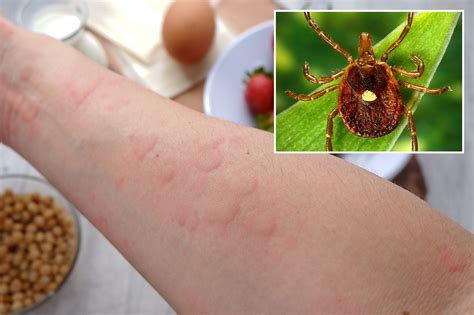 Incurable meat allergy from tick bite ‘turned my life upside down’: NJ man