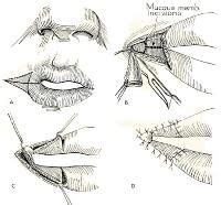 Microstomia Treatment & Management