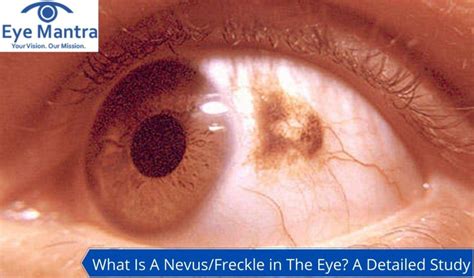 Nevus/Freckle in The Eye | Risk factors of Melanoma Nevi