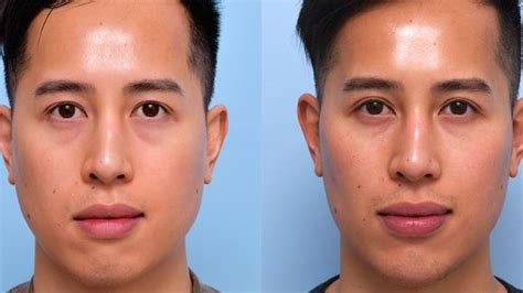 What Helps With Face Swelling From Wisdom Teeth Removal - Infoupdate.org