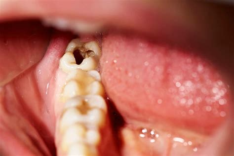 When does a Tooth Infection Become a dental emergency?