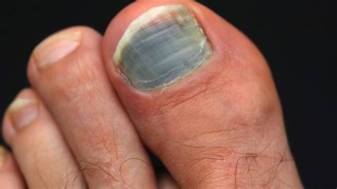 Do You Have A Dead Toenail? - Podiatry HQ Clinics