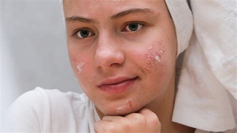 What Does It Really Mean To Have Clogged Pores?