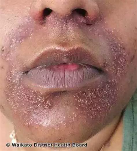 Eczema Around the Mouth and Lips: Your Guide | MyEczemaTeam