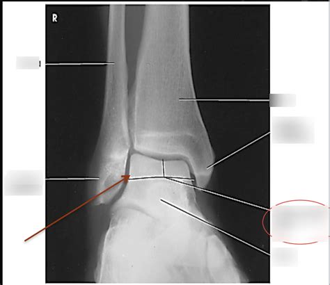 AP Oblique Ankle Mortise View (Anatomy) Diagram | Quizlet