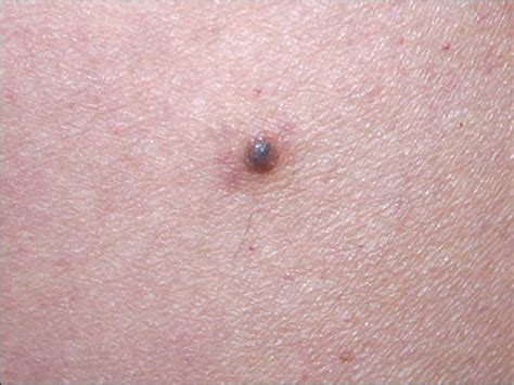 Black Mole Melanoma Skin Cancer