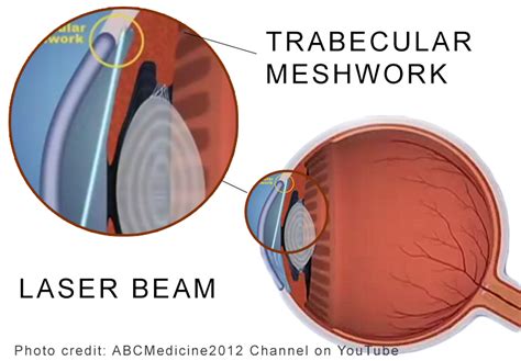 Introduction To Laser Trabeculoplasty (LT) | New-Glaucoma-Treatments.com