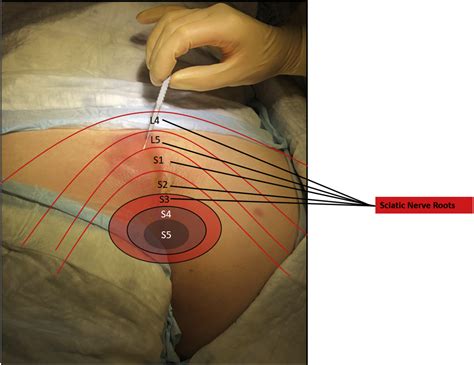 Ultrasound-Guided Transgluteal Sciatic Nerve Block for Gluteal Procedural Analgesia - Journal of ...