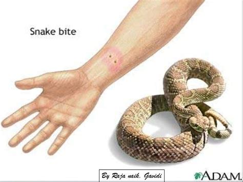 Snake bite by rajan naik gavidi