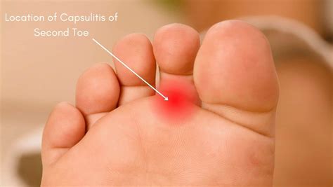 Capsulitis of the Second Toe: Symptoms, Causes & Treatment