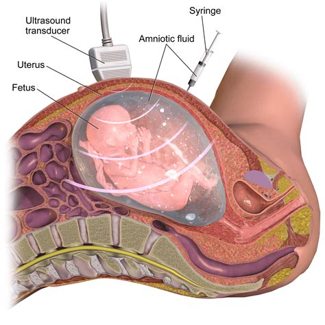 A Guide to an Amniocentesis Procedure