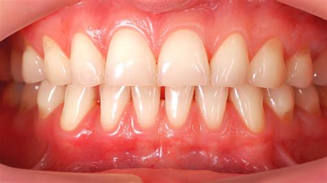 Receding gums causes, prevention and treatments - Dr. Karen Kang, DDS - Ebenezer Dental - New ...