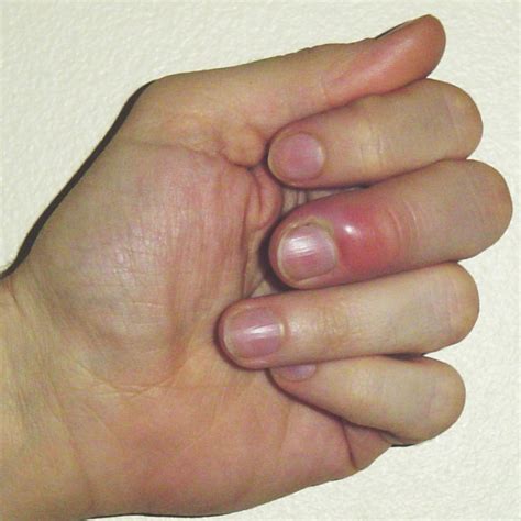 How To Get Rid Of Infection In Nail Cuticle - Women-Hairstyles.com