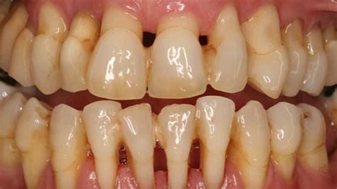 How to Prevent Gingivitis and Have Healthy Gums | Doug Lewis Dentistry