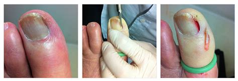 Ingrown Toenails | Treament & Surgery | Dr Gordon Slater | Foot & Ankle Surgeon