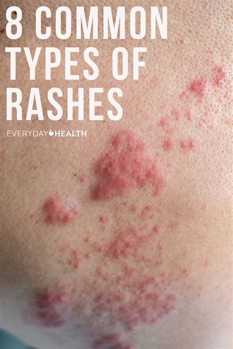Common Types Of Rashes And What They Look Like Types Of Rashes | Sexiz Pix