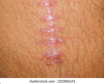 88 Colon Surgery Scar Royalty-Free Photos and Stock Images | Shutterstock