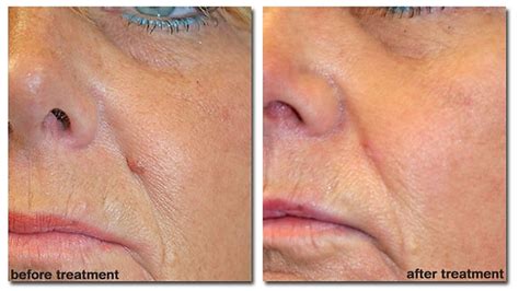 Sebaceous Hyperplasia Removal | ReviVe Skin & Aesthetics