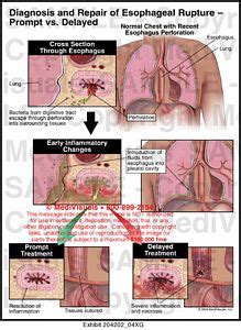 Repair-Esophageal Rupture Prompt-Delayed Medical Exhibit