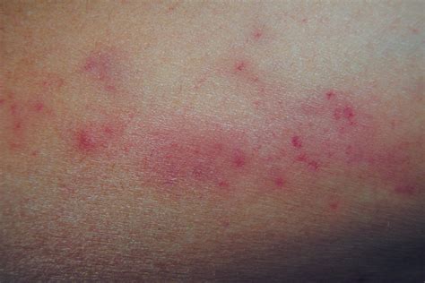 Petechiae Causes