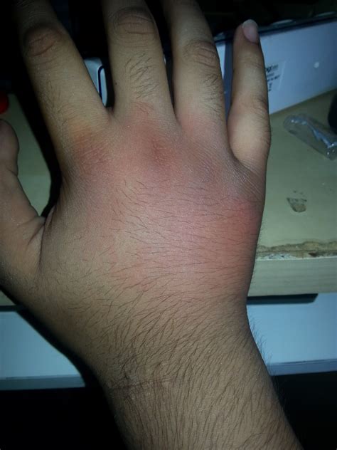 Whole hand swolen due to insect bite