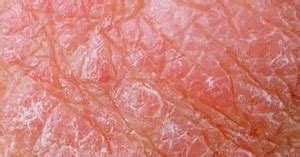 Red Scrotum Syndrome Symptoms, Causes, Contagious, Cure - Health Care ...