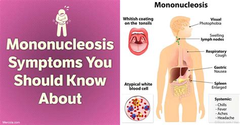 Mononucleosis Symptoms You Should Know About