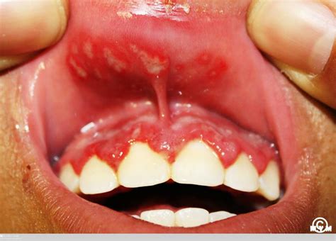 Herpes Simplex Stomatitis