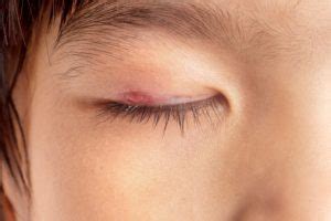 Eye Sty Causes & Symptoms - Wound Care Society