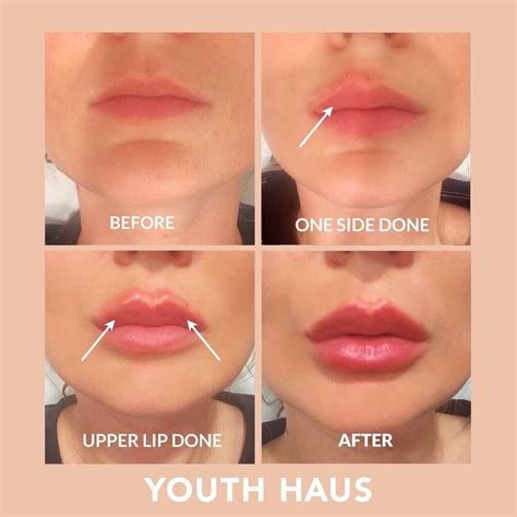 Collagen Lips Before After Pictures | Lipstutorial.org