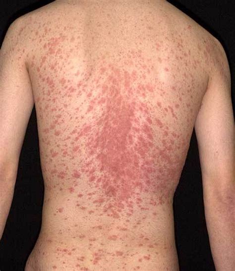 About Health: Pityriasis rosea