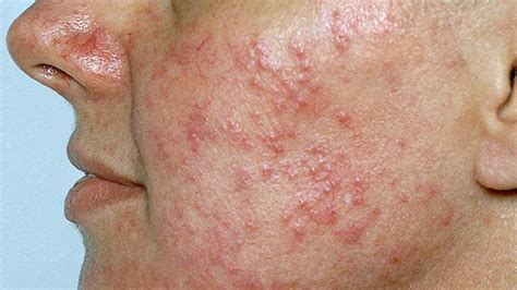 Ssurvivor: Malar Rash Lupus Vs Rosacea