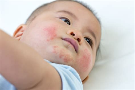 Baby Eczema Rash On Face