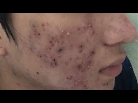 Blackhead Removal Videos October 2019 - HOWTOREMVO