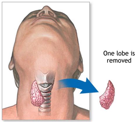 Thyroidectomy Procedure